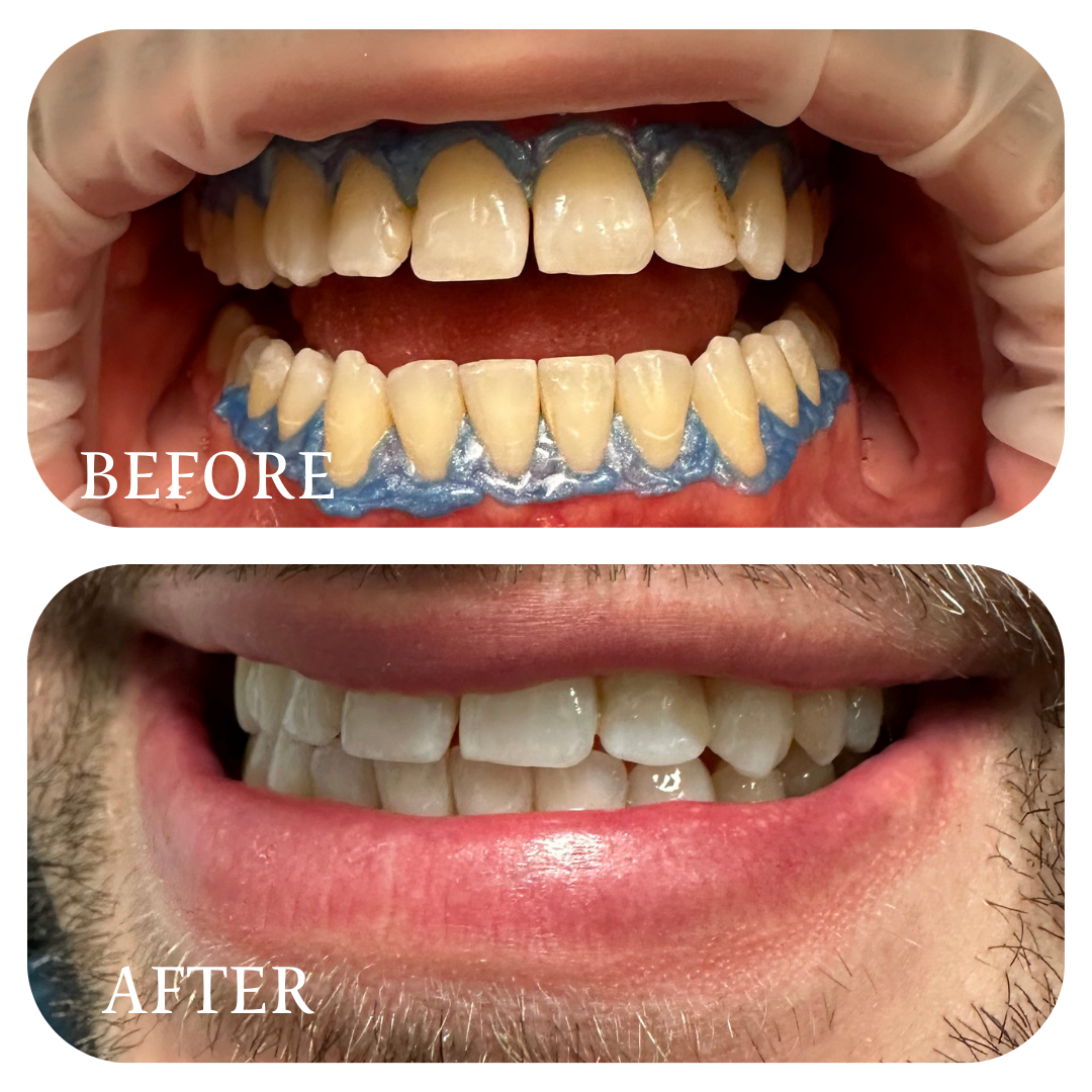 Smile Gallery | Real Patient Before & After Smiles at Smile 24